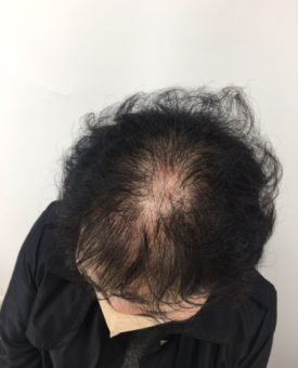 탈모모낭주사, 4달 치료받고 자신감 되찾은 50대 여성 사례 관련 이미지 6