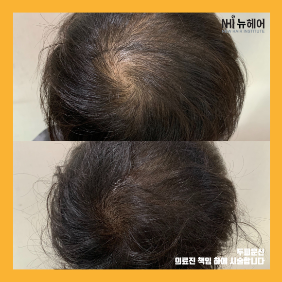정수리 탈모 두피문신 전후 사진 모음 l 뉴헤어 관련 이미지 1