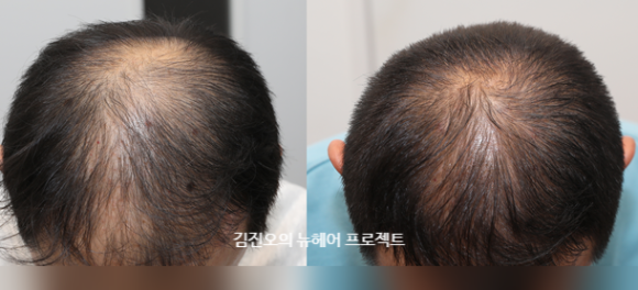 두타스테리드 10개월 복용 후, 이만큼 변했습니다! 관련 이미지 1