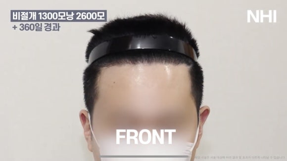 남자 앞머리 모발이식 l 탈모 모발이식 1년 전후 사진 관련 이미지 5