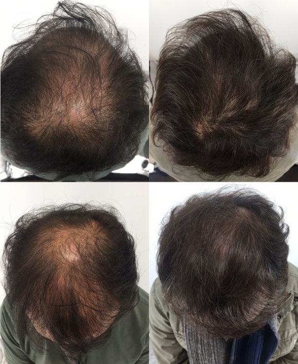 남성탈모치료 6개월 받은 50대 남성 후기 관련 이미지 5