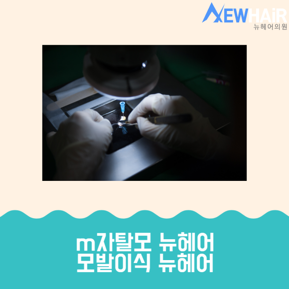m자탈모 해결은 모발이식 관련 이미지 6