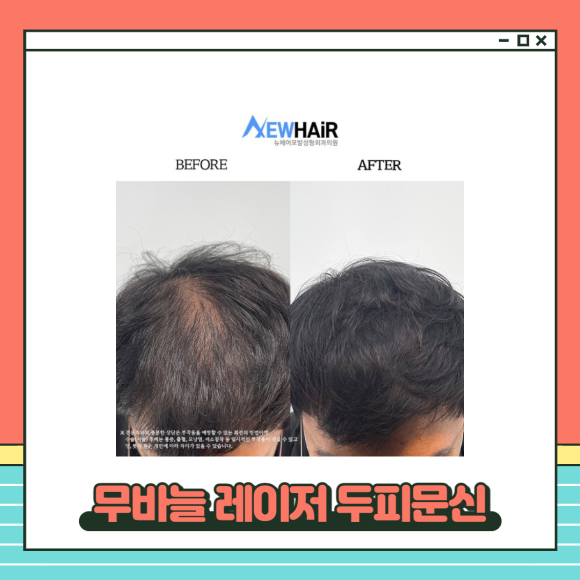 정수리 가르마두피문신 수술없이 탈모해결 관련 이미지 4