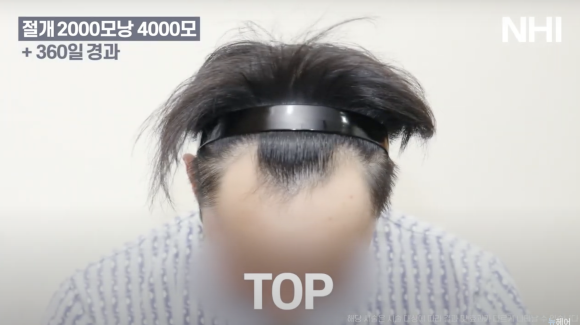 뉴헤어 남자 모발이식 후기(2000모낭) 모발이식 1년 효과 후기 관련 이미지 5