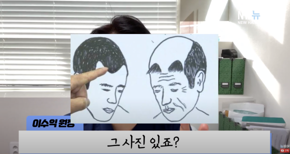 모발이식 후 탈모약 계속 먹어야 할까? l 모발이식 후 탈모치료 관련 이미지 6