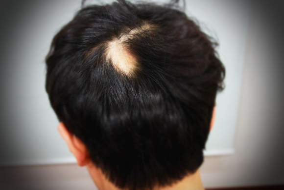 원형탈모 있는 사람, 심혈관계 질환 위험성 높다(탈모와 심혈질환 관계) 관련 이미지 1