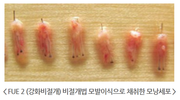 비절개 모발이식 흉터, 줄일 수 있는 노하우 1가지 관련 이미지 5