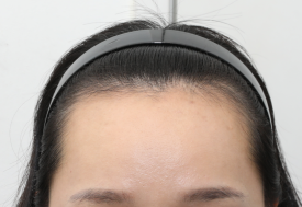 넓은이마 모발이식, 평생 유지되는 조건은 무엇일까? 관련 이미지 1