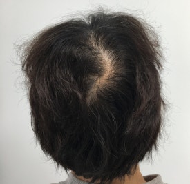 항암 탈모치료, 모발 회복에 도움이 되는 치료법은? 관련 이미지 4
