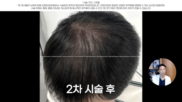 정수리탈모문신 시술직후 나타나는 효과?(전후사진) 관련 이미지 15