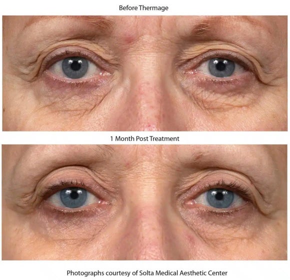 Thermage Is Good for Fine Wrinkles — Why Thermage FLX Is So Popular at Just Plastic Surgery! image 11