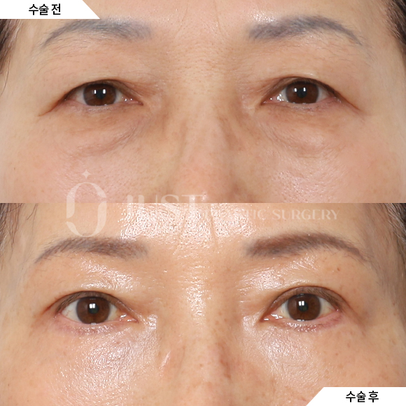 Brow Lift: Just Plastic Surgery Reveals the Secret to Great Results! image 5