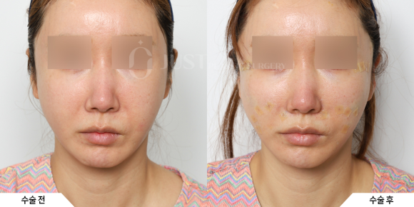 What Is Ozempic Face? Just Plastic Surgery Presents Solutions! image 4