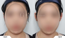 &ldquo;귀 필러 하면 얼굴 작아진다?&rdquo; 성형외과 전문의가 말하는 요정귀 필러의 효과와 매력 관련 이미지 7
