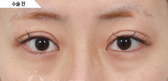 내가&hellip; 꺼진 눈이라고요?! (꺼진 눈은 어떤 눈인지, 알려드립니다) 관련 이미지 6