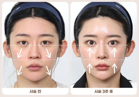 Midface Lifting: Start with Peach Silhouette Lifting at Just. image 4