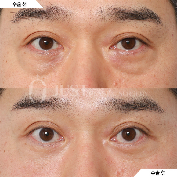 Drawbacks of Lower Eyelid Fat Repositioning—and Why Combining It with Peach Lifting Can Help! image 4