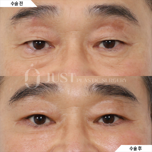 How to Address Under-Eye Wrinkles—Find Out When Lower Blepharoplasty Is Really Needed! image 4