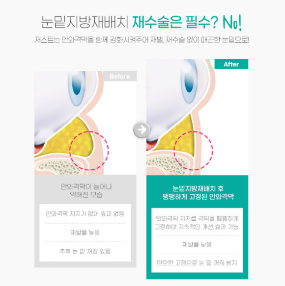 What Is the Most Common Question During a Lower Eyelid Fat Repositioning Consultation? Part 1. What Improvements Does It Make? image 5