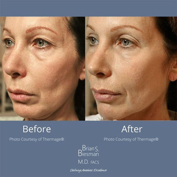 Thermage Is Good for Fine Wrinkles — Why Thermage FLX Is So Popular at Just Plastic Surgery! image 5