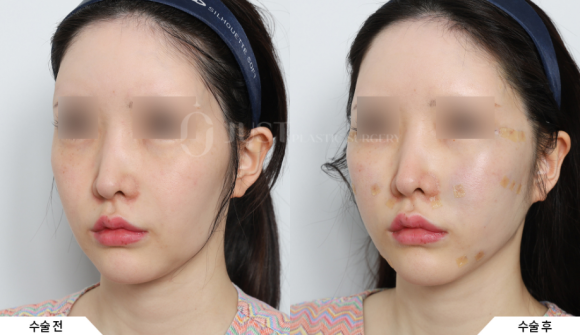 Midface Lifting: Start with Peach Silhouette Lifting at Just. image 6