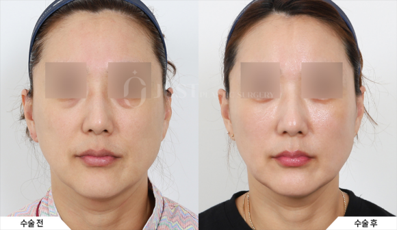 Drawbacks of Lower Eyelid Fat Repositioning—and Why Combining It with Peach Lifting Can Help! image 6