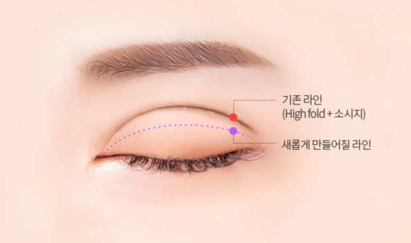 Double Eyelid Revision Surgery: The Solutions for “Sausage Eyes” and Uneven Eyes Are Different image 2