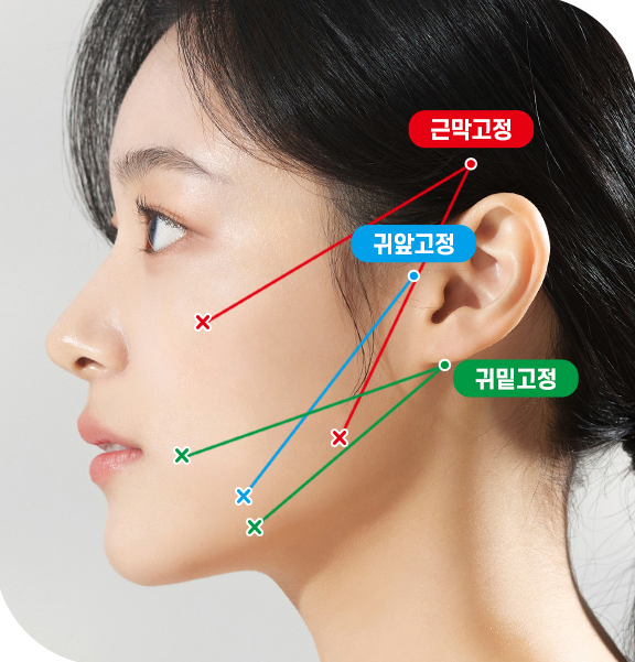 실리프팅, 안면거상 하던 성형외과 전문의가 왜 시작하게 되었는지? 관련 이미지 7