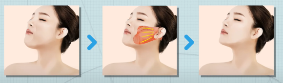 저스트 성형외과만의 특별한 안면거상술! 관련 이미지 4