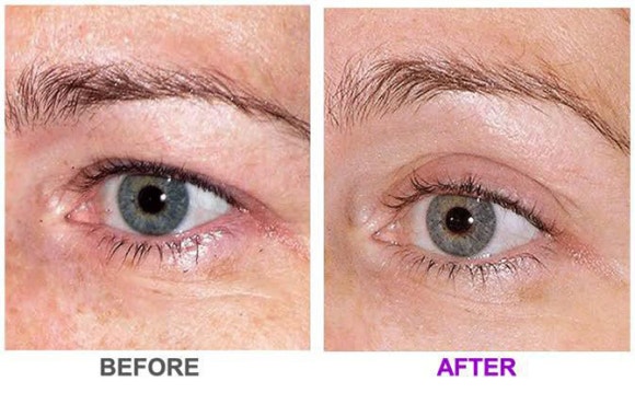 Thermage Is Good for Fine Wrinkles — Why Thermage FLX Is So Popular at Just Plastic Surgery! image 12
