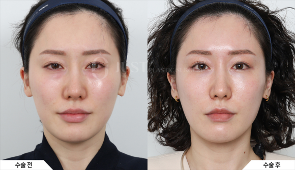 Drawbacks of Lower Eyelid Fat Repositioning—and Why Combining It with Peach Lifting Can Help! image 9