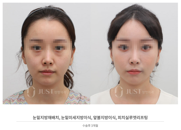 Thread Lifting Q&A, Part 9: What procedures work well together? image 1