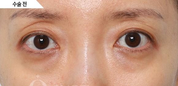 내가&hellip; 꺼진 눈이라고요?! (꺼진 눈은 어떤 눈인지, 알려드립니다) 관련 이미지 4