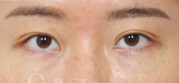 Double Eyelid Revision Surgery: The Solutions for “Sausage Eyes” and Uneven Eyes Are Different image 5