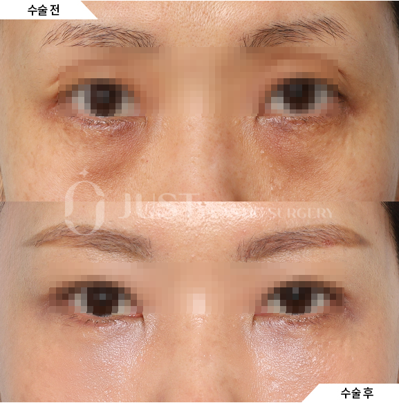 What Is the Most Common Question During a Lower Eyelid Fat Repositioning Consultation? Part 1. What Improvements Does It Make? image 2