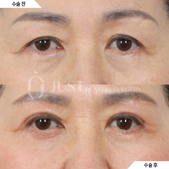 Brow Lift: Just Plastic Surgery Reveals the Secret to Great Results! image 4