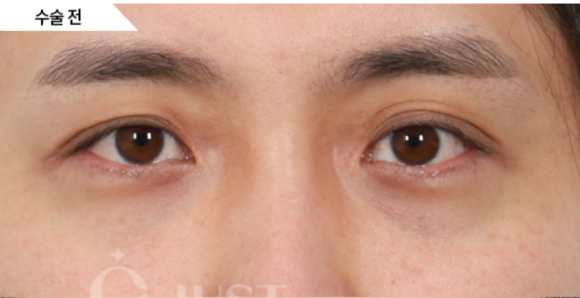 Under-Eye Fat Repositioning: 2 Self-Check Methods Explained by a Plastic Surgeon with 21 Years of Experience! image 5