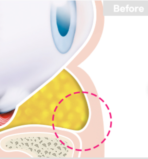 Under-Eye Fat Repositioning: 2 Self-Check Methods Explained by a Plastic Surgeon with 21 Years of Experience! image 1