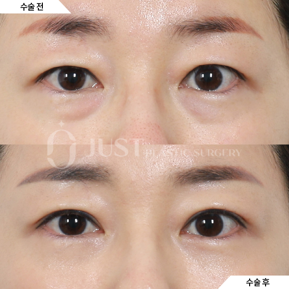 Drawbacks of Lower Eyelid Fat Repositioning—and Why Combining It with Peach Lifting Can Help! image 1