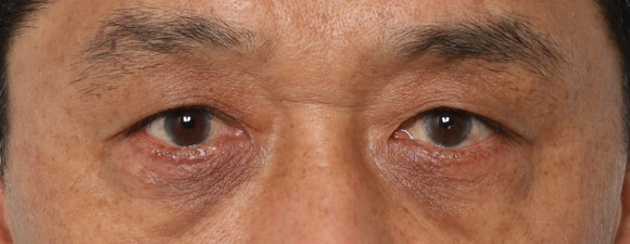 How to Address Under-Eye Wrinkles—Find Out When Lower Blepharoplasty Is Really Needed! image 1