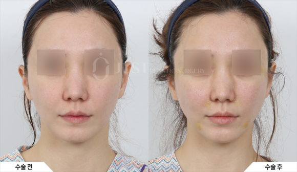 Drawbacks of Lower Eyelid Fat Repositioning—and Why Combining It with Peach Lifting Can Help! image 7