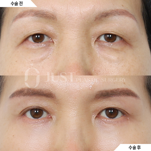 How to Address Under-Eye Wrinkles—Find Out When Lower Blepharoplasty Is Really Needed! image 3