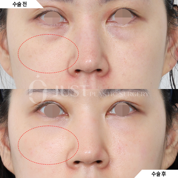 눈밑지 지방이식은 이렇게! (앞볼 + 인디언주름) 관련 이미지 1