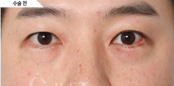 Under-Eye Fat Repositioning: 2 Self-Check Methods Explained by a Plastic Surgeon with 21 Years of Experience! image 4