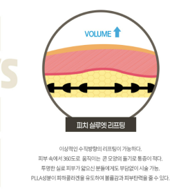 Thread Lifting Q&A Part 1: What kind of threads are used? image 3