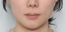 수술 흉터 없이 인중을 줄이는 방법? 관련 이미지 2