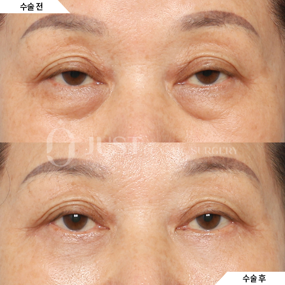 How to Address Under-Eye Wrinkles—Find Out When Lower Blepharoplasty Is Really Needed! image 5