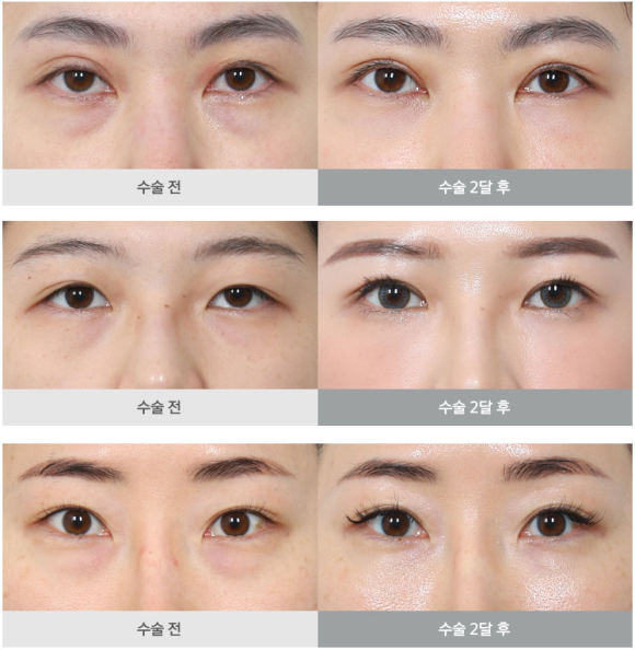 눈밑 수술, 이제는 국민 성형수술이 되다? (눈밑지방재배치와 하안검의 차이) 관련 이미지 3
