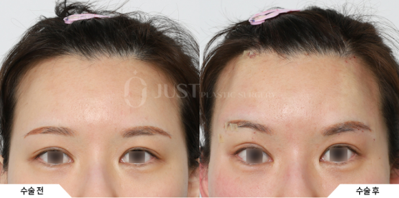 Just Plastic Surgery Clinic Aptos vs. Other Thread Lifting: 2 Selection Criteria Revealed image 3