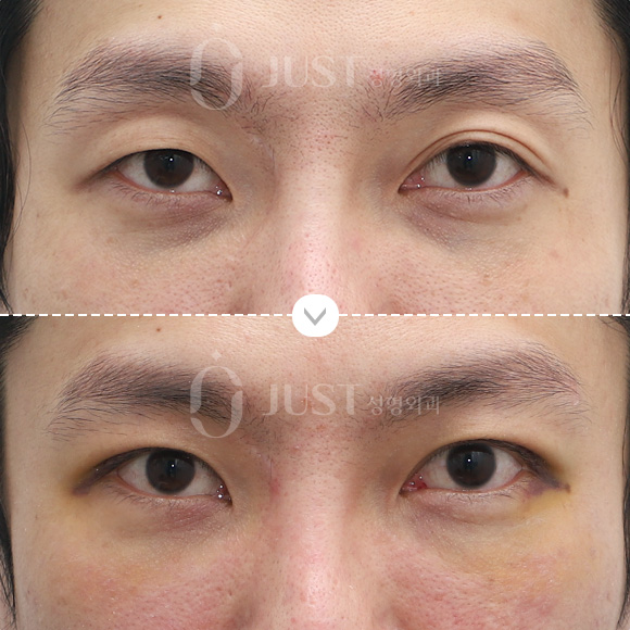 갑자기 나이들어 생긴 느끼한 쌍꺼풀, 비대칭 쌍꺼풀 어떻게 해야 하나요? 관련 이미지 2